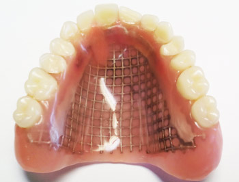 Dentier avec une grille métalique coulée et incrustée
