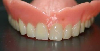Réparation dentier cassé, remplacement de dents cassées