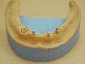 Implant dentaire type bouton pression