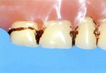 Dentier incrustation de nicotine